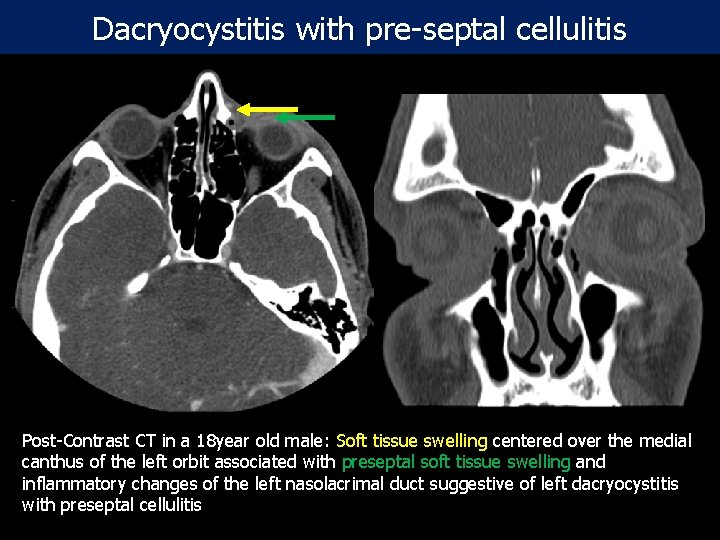Dacryocystitis with pre-septal cellulitis Post-Contrast CT in a 18 year old male: Soft tissue