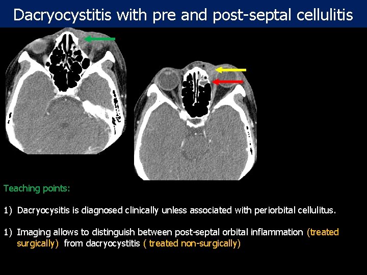 Dacryocystitis with pre and post-septal cellulitis Teaching points: Post- contrast CT scan: Axial and