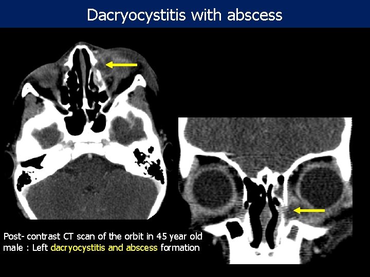 Dacryocystitis with abscess Post- contrast CT scan of the orbit in 45 year old