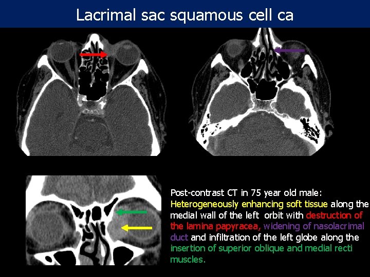 Lacrimal sac squamous cell ca Post-contrast CT in 75 year old male: Heterogeneously enhancing