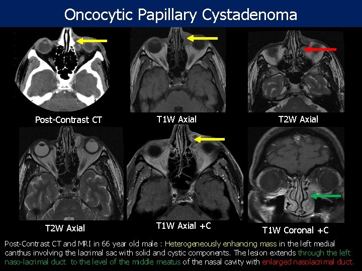 Oncocytic Papillary Cystadenoma Post-Contrast CT T 2 W Axial T 1 W Axial +C