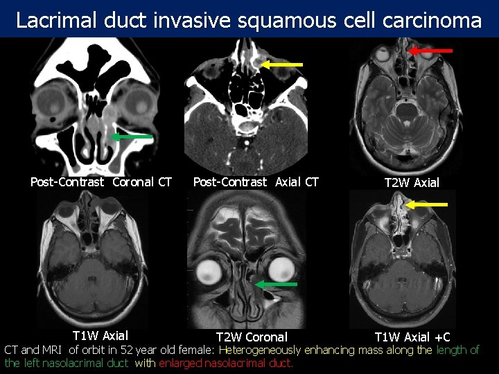 Lacrimal duct invasive squamous cell carcinoma Post-Contrast Coronal CT T 1 W Axial Post-Contrast