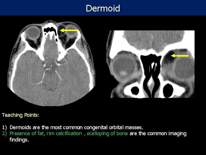 Dermoid Teaching Points: Post- contrast CT scan of the orbit in 28 year old