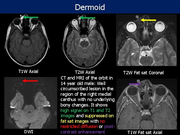 Dermoid T 1 W Axial DWI T 2 W Axial CT and MRI of
