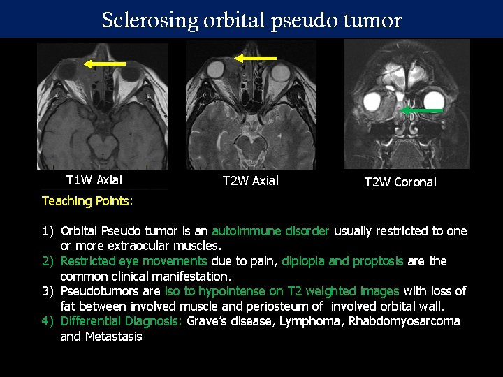 Sclerosing orbital pseudo tumor T 1 W Axial Teaching Points: T 2 W Axial