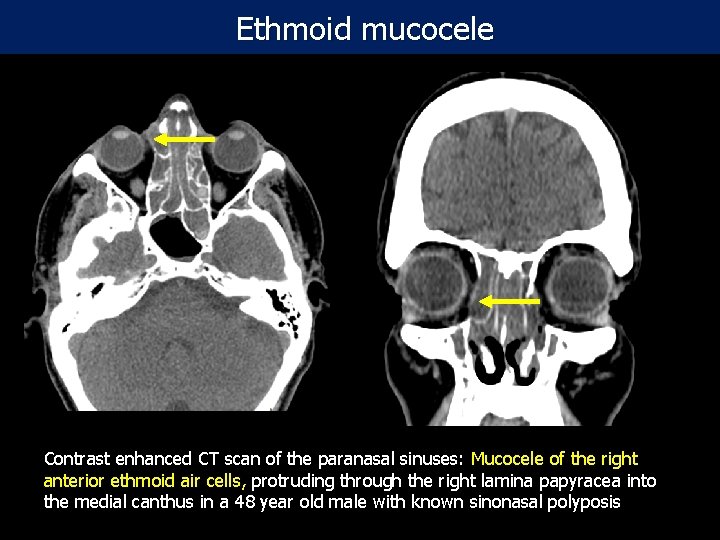  Ethmoid mucocele Contrast enhanced CT scan of the paranasal sinuses: Mucocele of the