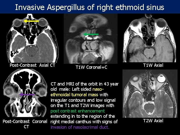Invasive Aspergillus of right ethmoid sinus Post-Contrast Axial CT T 1 W Coronal+C CT