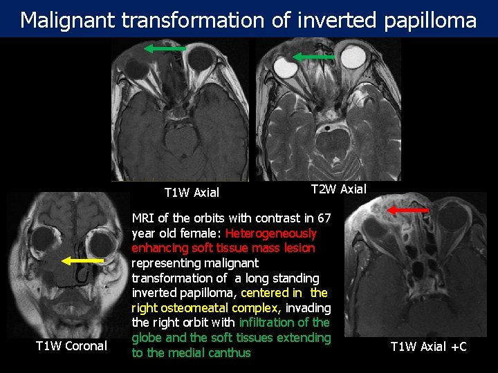 Malignant transformation of inverted papilloma T 1 W Axial T 1 W Coronal T