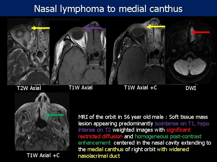 Nasal lymphoma to medial canthus T 2 W Axial T 1 W Axial +C