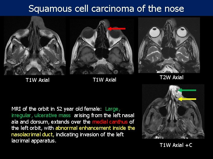 Squamous cell carcinoma of the nose T 1 W Axial MRI of the orbit
