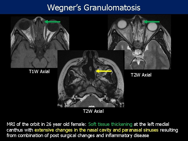Wegner’s Granulomatosis T 1 W Axial T 2 W Axial MRI of the orbit