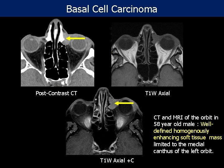 Basal Cell Carcinoma Post-Contrast CT T 1 W Axial CT and MRI of the