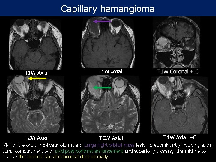 Capillary hemangioma T 1 W Axial T 2 W Axial T 1 W Axial