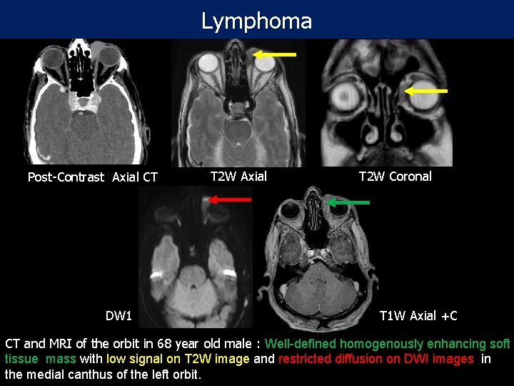 Lymphoma Post-Contrast Axial CT DW 1 T 2 W Axial T 2 W Coronal