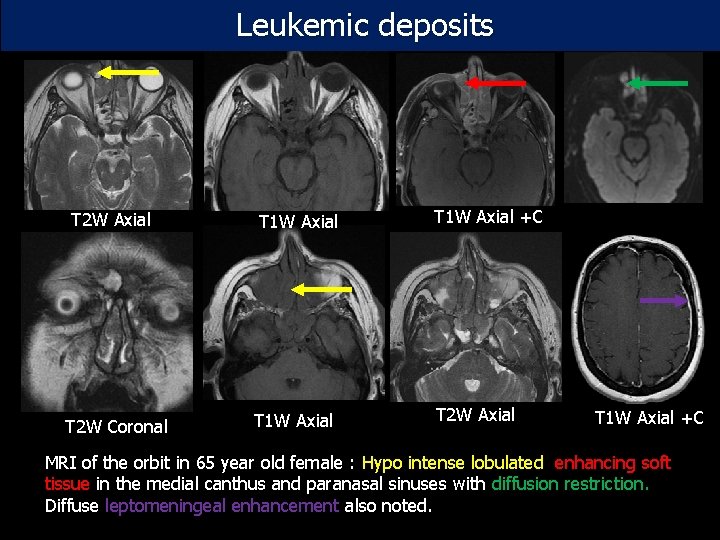 Leukemic deposits T 2 W Axial T 1 W Axial +C T 2 W