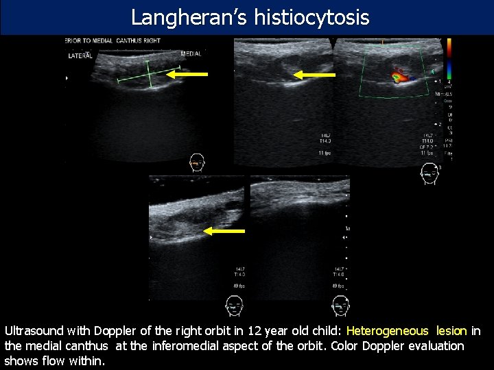 Langheran’s histiocytosis Ultrasound with Doppler of the right orbit in 12 year old child:
