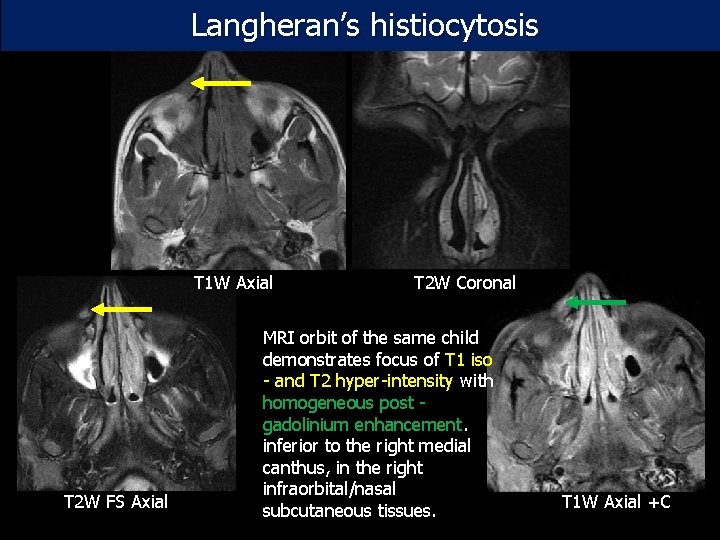 Langheran’s histiocytosis T 1 W Axial T 2 W FS Axial T 2 W