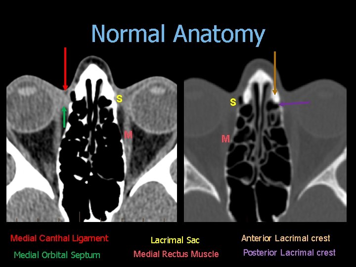 Normal Anatomy S S M Medial Canthal Ligament Medial Orbital Septum M Lacrimal Sac