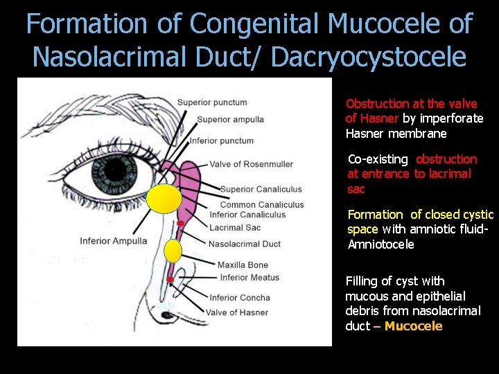 Formation of Congenital Mucocele of Nasolacrimal Duct/ Dacryocystocele Obstruction at the valve of Hasner