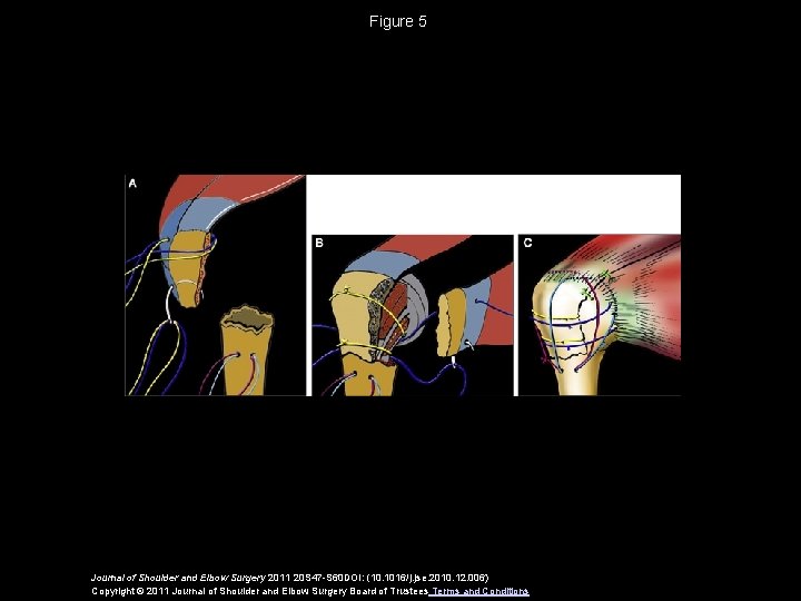 Proximal humeral fractures in younger patients fixation techniques