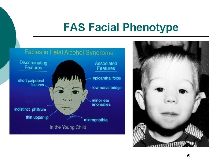 FAS Facial Phenotype 5 