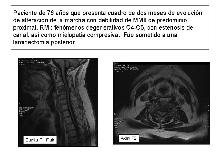 Paciente de 76 años que presenta cuadro de dos meses de evolución de alteración