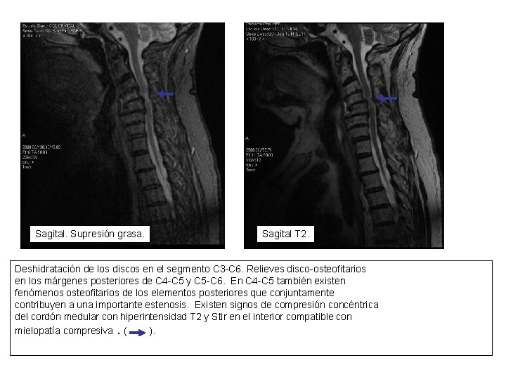 Sagital. Supresión grasa. Sagital T 2. Deshidratación de los discos en el segmento C