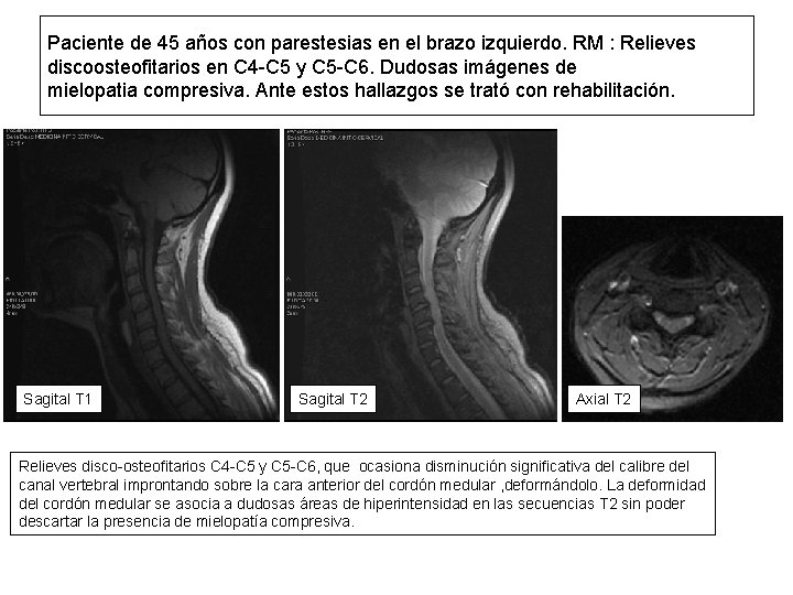 Paciente de 45 años con parestesias en el brazo izquierdo. RM : Relieves discoosteofitarios