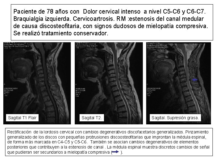 Paciente de 78 años con Dolor cervical intenso a nivel C 5 -C 6