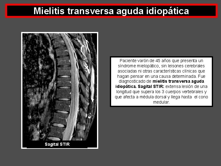 Mielitis transversa aguda idiopática Paciente varón de 45 años que presenta un síndrome mielopático,