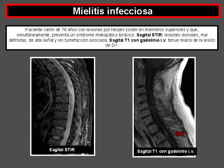 Mielitis infecciosa Paciente varón de 78 años con lesiones por herpes zoster en miembros