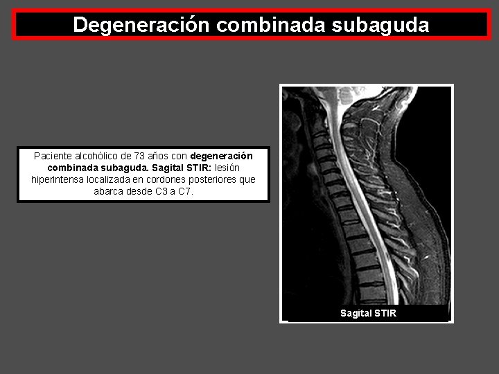 Degeneración combinada subaguda Paciente alcohólico de 73 años con degeneración combinada subaguda. Sagital STIR: