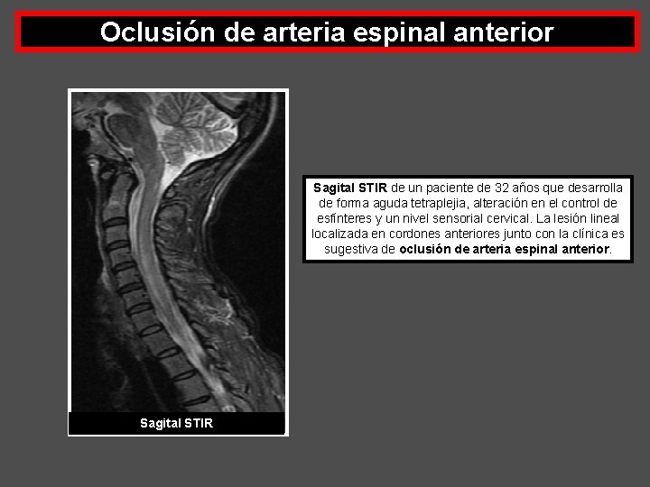 Oclusión de arteria espinal anterior Sagital STIR de un paciente de 32 años que