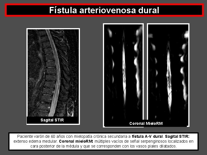Fístula arteriovenosa dural Sagital STIR Coronal Mielo. RM Paciente varón de 60 años con