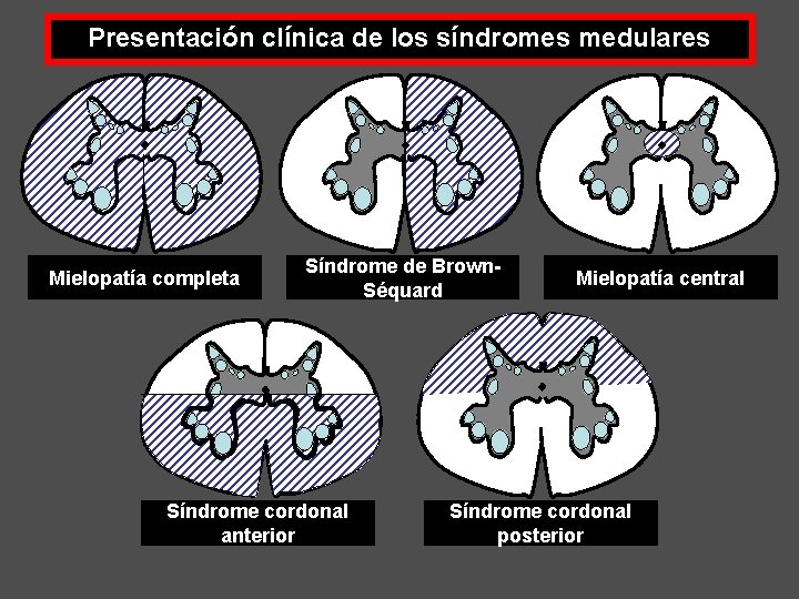 Presentación clínica de los síndromes medulares Mielopatía completa Síndrome de Brown. Séquard Síndrome cordonal