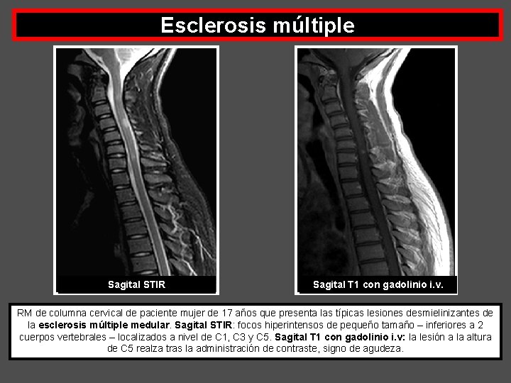 Esclerosis múltiple Sagital STIR Sagital T 1 con gadolinio i. v. RM de columna
