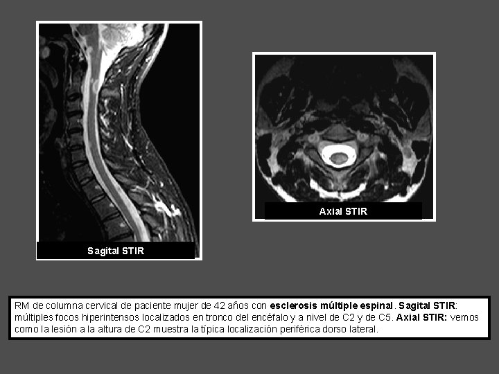 Axial STIR Sagital STIR RM de columna cervical de paciente mujer de 42 años
