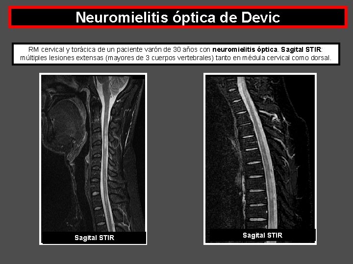 Neuromielitis óptica de Devic RM cervical y torácica de un paciente varón de 30