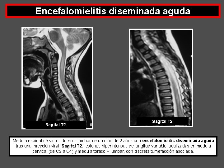 Encefalomielitis diseminada aguda Sagital T 2 Médula espinal cérvico – dorso – lumbar de