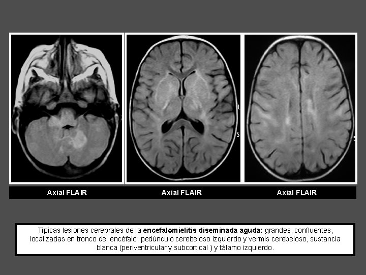 Axial FLAIR Típicas lesiones cerebrales de la encefalomielitis diseminada aguda: grandes, confluentes, localizadas en