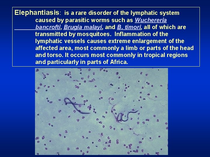 Elephantiasis: is a rare disorder of the lymphatic system caused by parasitic worms such
