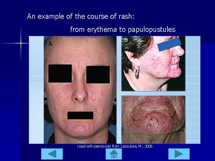 An example of the course of rash: from erythema to papulopustules Used with permission