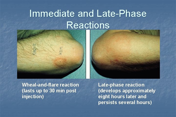Immediate and Late-Phase Reactions Wheal-and-flare reaction (lasts up to 30 min post injection) Late-phase