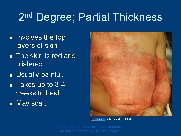 2 nd Degree; Partial Thickness n n n Involves the top layers of skin.