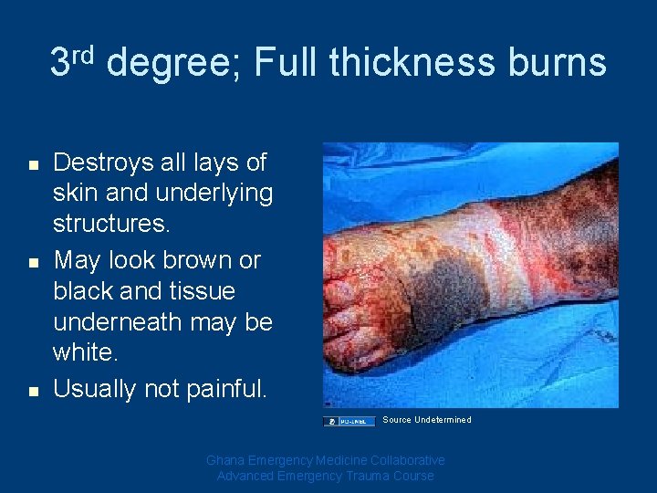 3 rd degree; Full thickness burns n n n Destroys all lays of skin