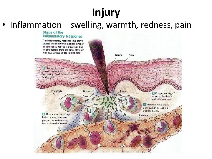 Injury • Inflammation – swelling, warmth, redness, pain 
