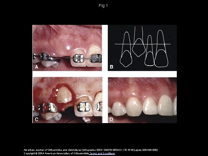 Fig 1 American Journal of Orthodontics and Dentofacial Orthopedics 2004 126278 -283 DOI: (10.