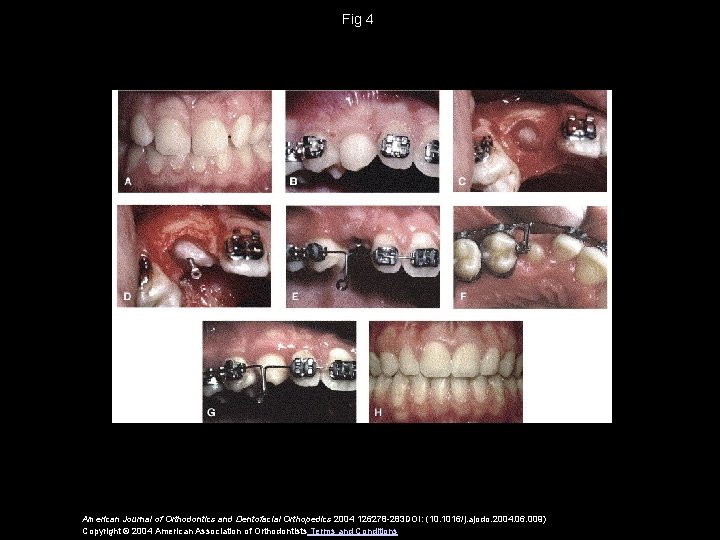 Fig 4 American Journal of Orthodontics and Dentofacial Orthopedics 2004 126278 -283 DOI: (10.