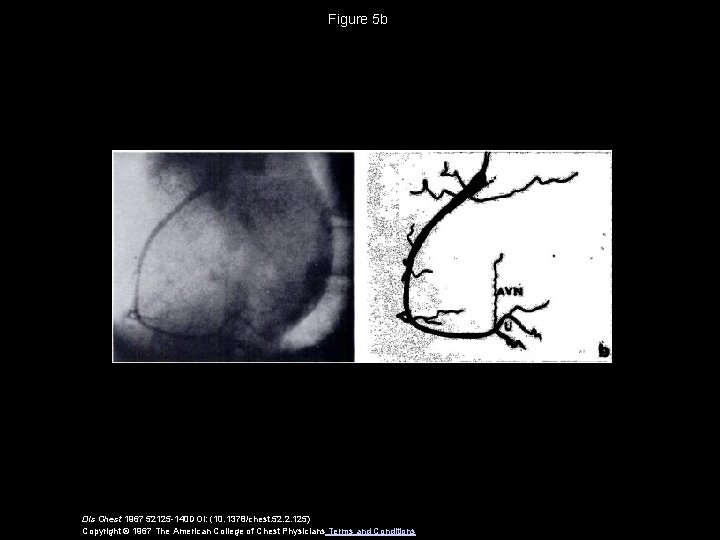 Figure 5 b Dis Chest 1967 52125 -140 DOI: (10. 1378/chest. 52. 2. 125)