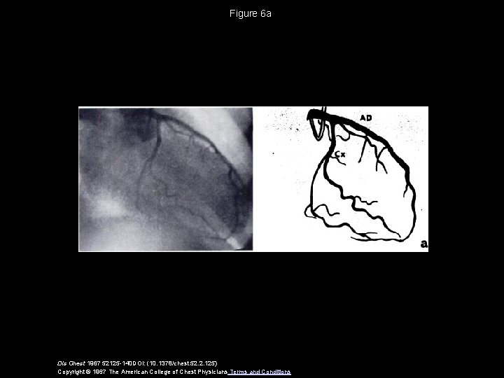 Figure 6 a Dis Chest 1967 52125 -140 DOI: (10. 1378/chest. 52. 2. 125)